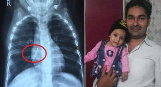 Ampoule LED trouvée dans les poumons de l'enfant. Les médecins l'enlèvent en 2 minutes