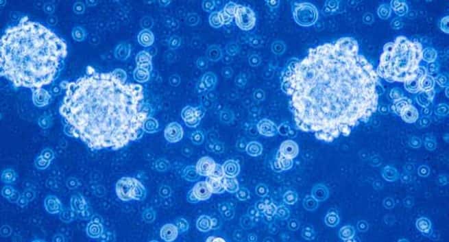 Journée mondiale de la paralysie cérébrale 2017: Comment la thérapie par cellules souches peut aider à traiter la paralysie cérébrale 4 D&C-stem cells and cancer-THS