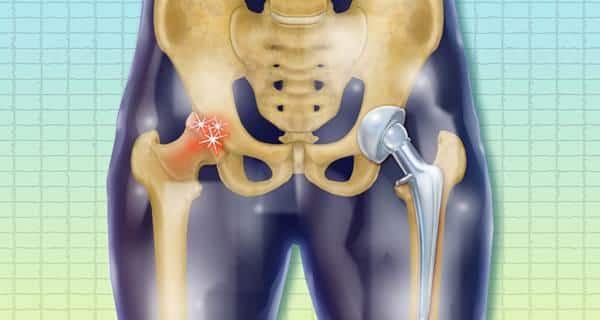 hip replacement surgery