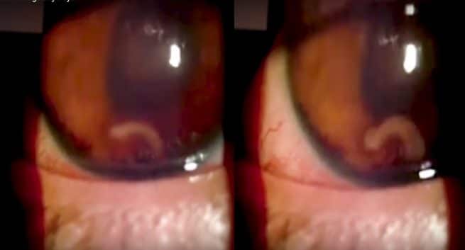 Mexique: Worm creuse un trou dans l'œil d'un garçon de 17 ans provoquant une perte de vision permanente (voir la vidéo)