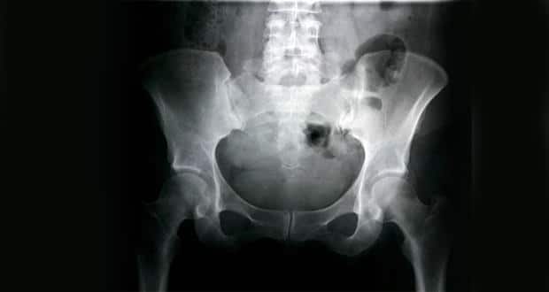 Hip replacement surery