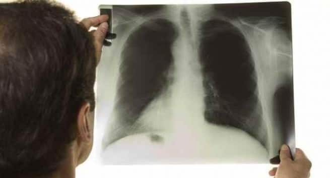 Quatre initiatives de santé du gouvernement en 2018 pour une meilleure Inde 4 tuberculosis