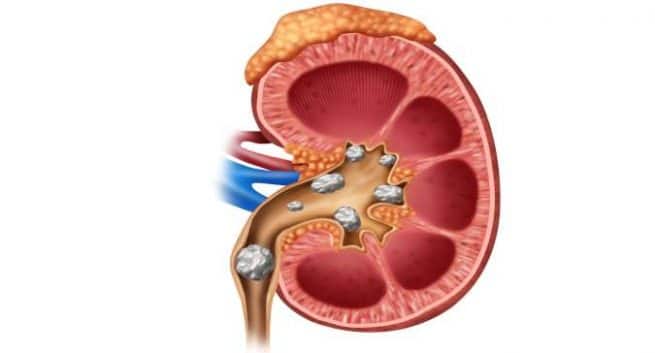 Un médicament expérimental contre l'obésité peut prévenir les calculs rénaux