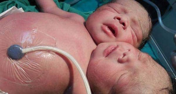 conjoined twins sucessfully separated