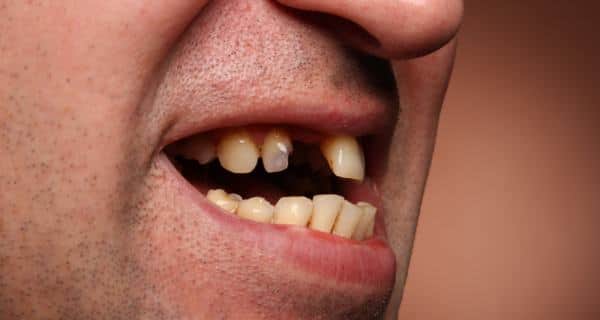 bad teeth