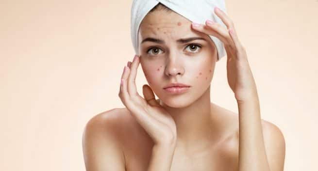 Peanuts acne health benefits