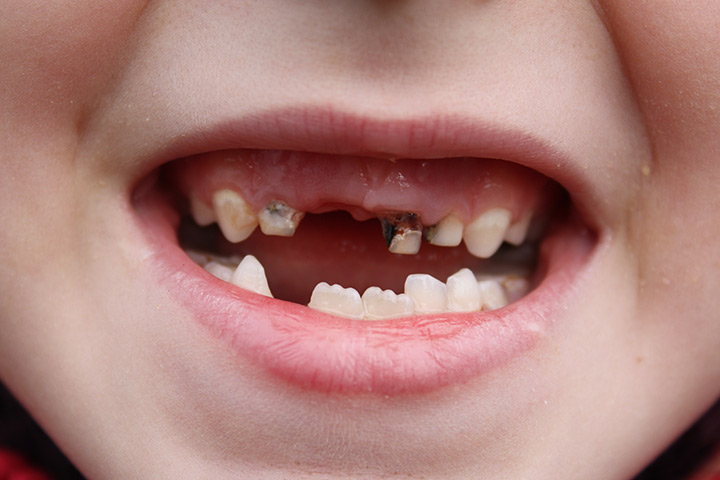 Sind Flaschen schlecht für Babys Zähne? Ein Kinderzahnarzt erklärt1