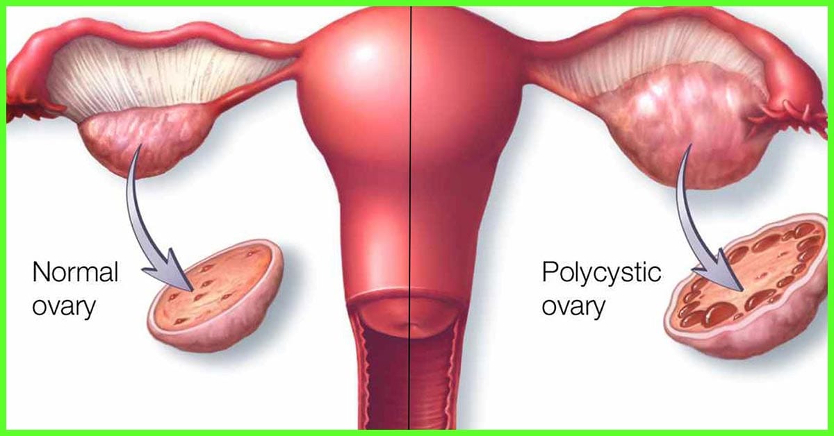 8 besten Fruchtbarkeitsmedikamente für Frauen mit PCOS und Ovulationsproblemen