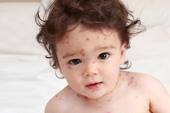 Ursachen von Akne bei kleinen Kindern