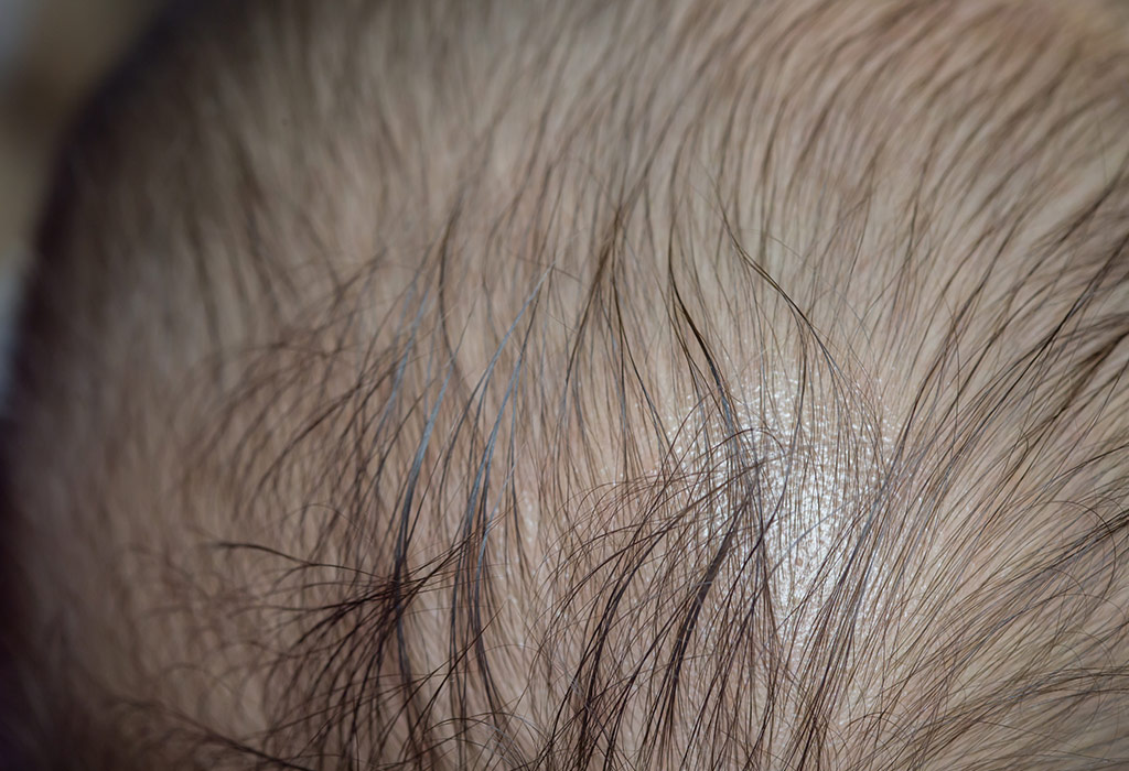 Alopezie Areata bei Kindern