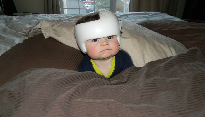 Ihr Baby braucht also einen Helm? Es wird in Ordnung sein, ich verspreche es