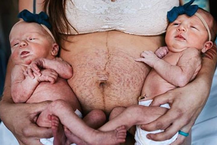 Mutter teilt rohe Fotos von Schwangerschaftsstreifen