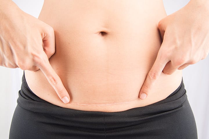 Was passiert wirklich mit Ihrem Magen nach einem Kaiserschnitt?