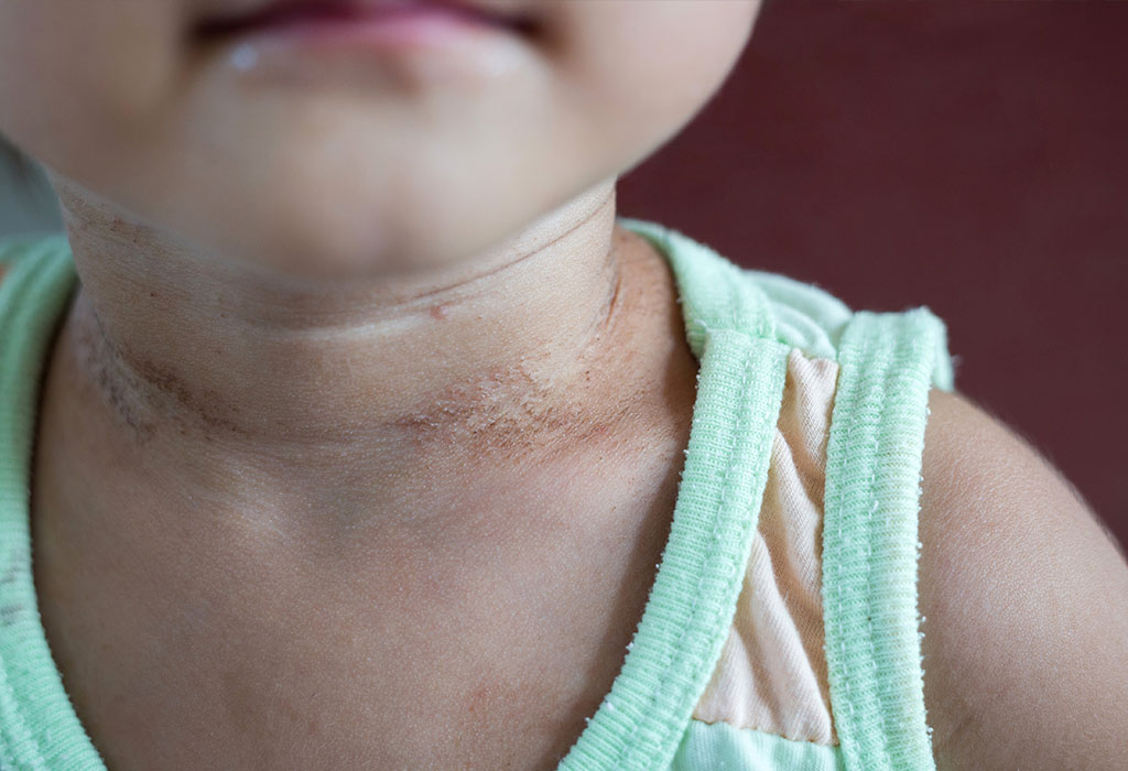 Wie man Halsausschlag bei Säuglingen behandelt und verhindert