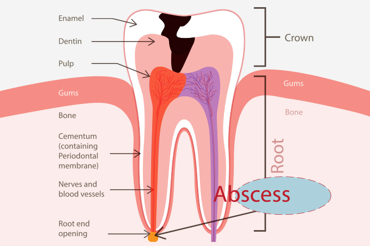 Zahnabszess während der Schwangerschaft