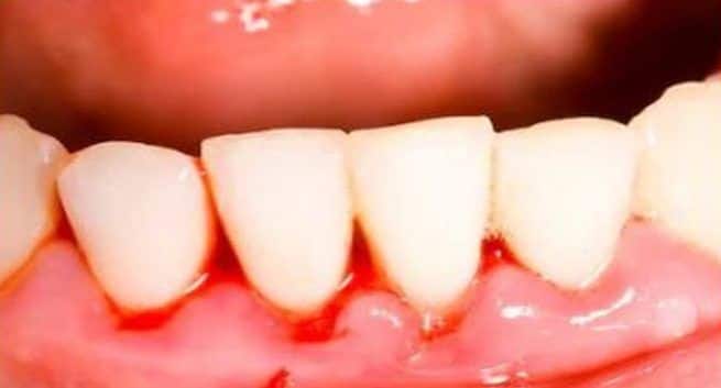 tooth decay - tooth decay in children - preventing tooth decay - effective way for parents to help avoid pain and infection from decay -