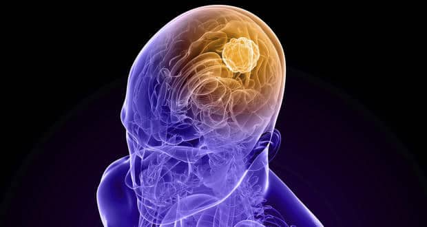 Hirntumoren können auf eine Immuntherapie ansprechen: Studie