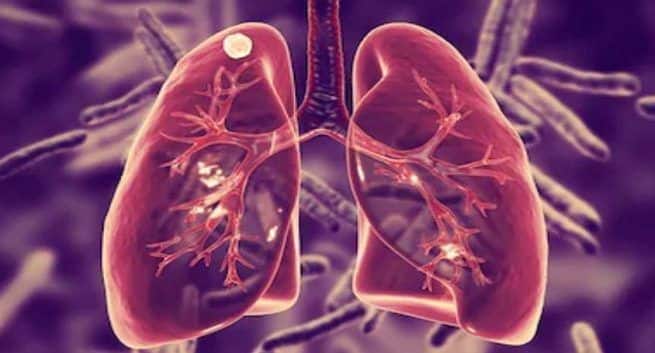 lungs-disease