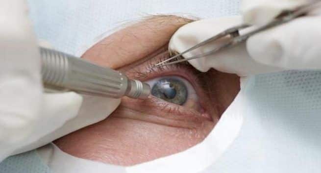 cataract-surgery-main-image