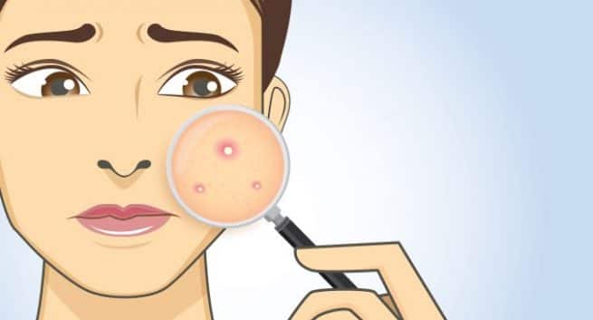Pimples benefits Hindi