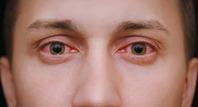 Red eyes due to overdose of erectile dysfuction medication