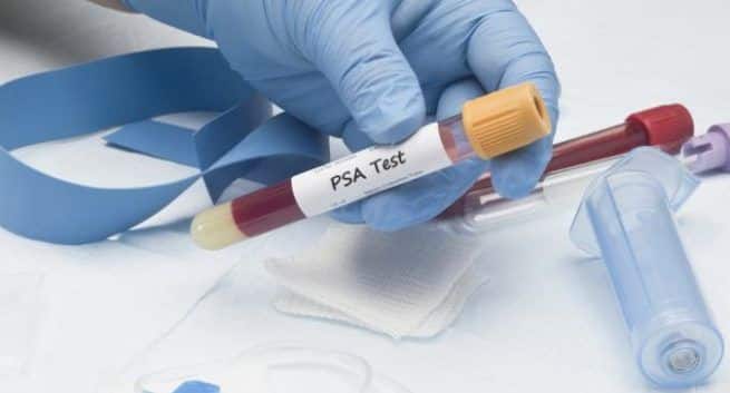 PSA test for prostate