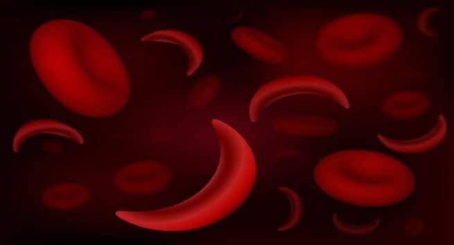Sickle cell anaemia
