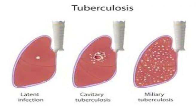 Welttuberkulose-Tag 2020: TB-Tests, über die Sie Bescheid wissen müssen
