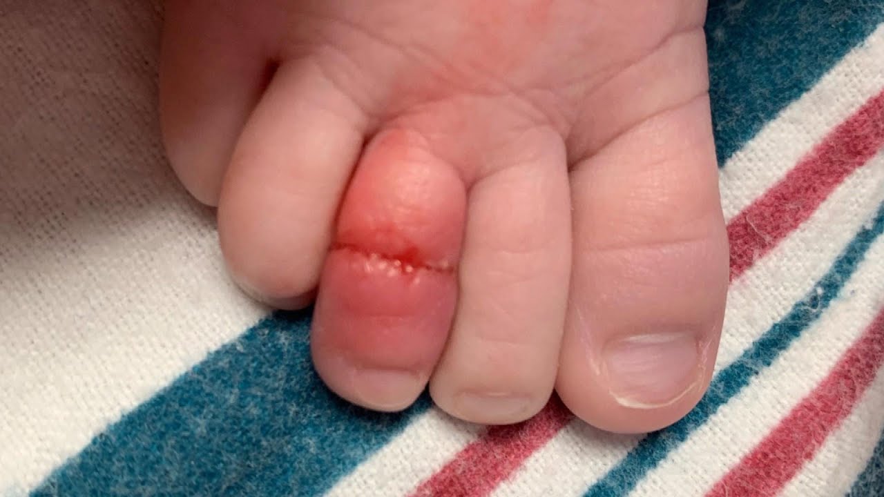 tourniquet syndrom baby