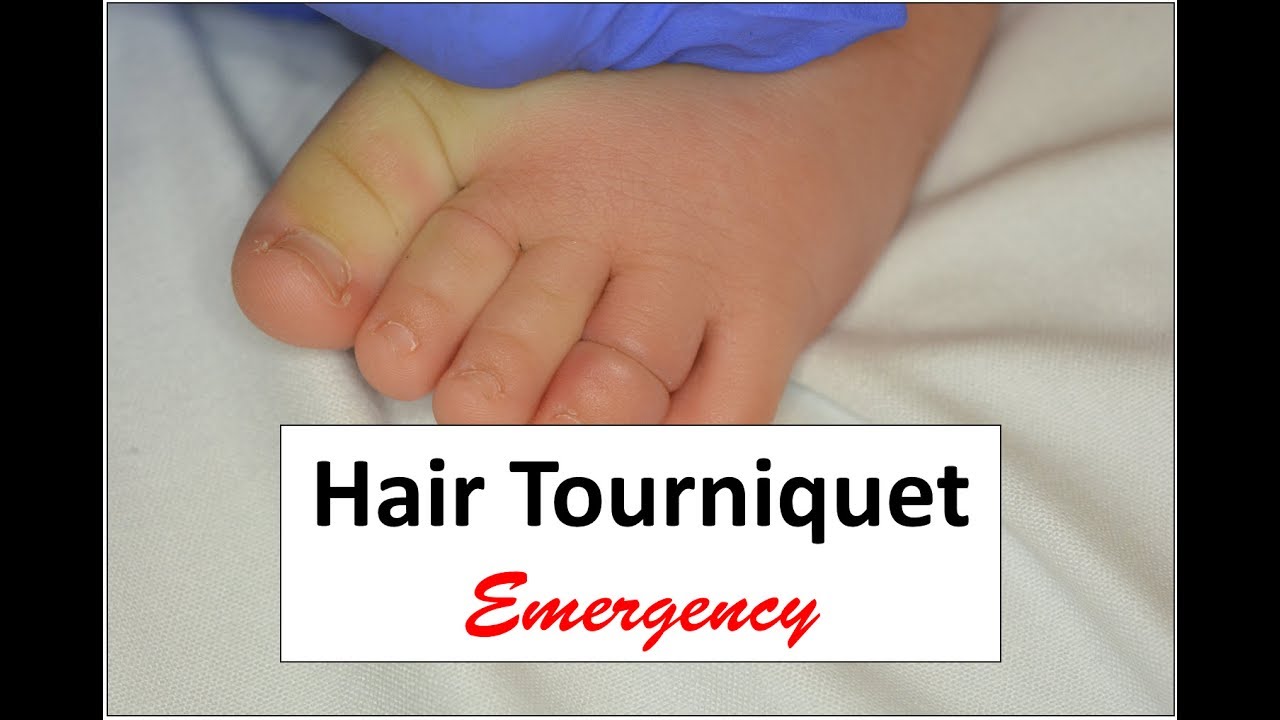 tourniquet syndrom