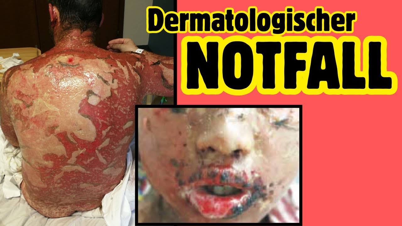 toxische nekrolyse