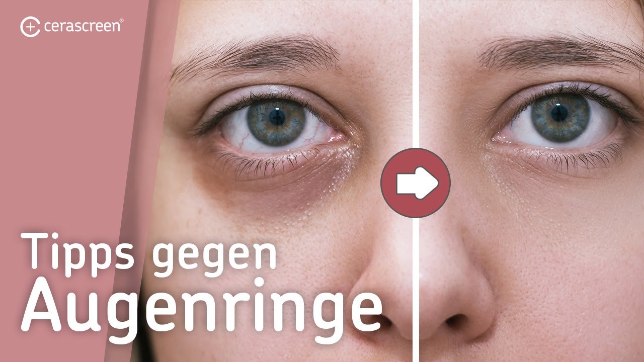 dunkle ringe unter den augen eines babys ursachen und heilmittel