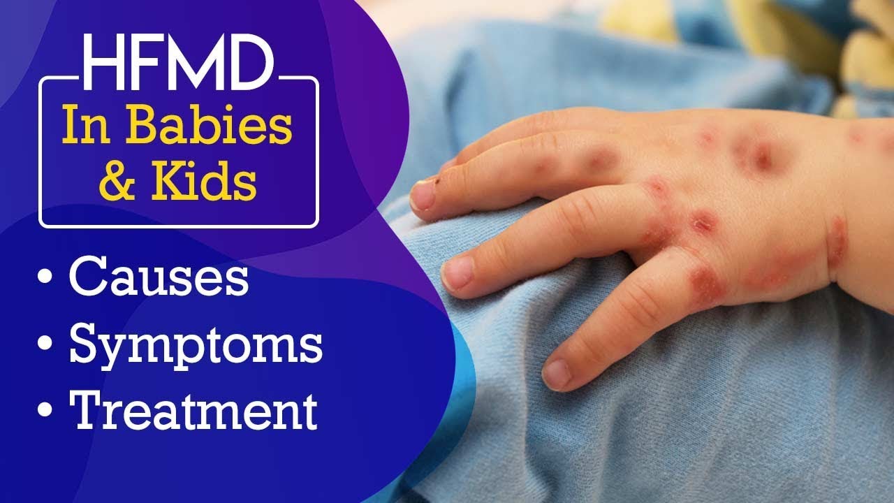 hand maul und klauenseuche hfmd bei babys